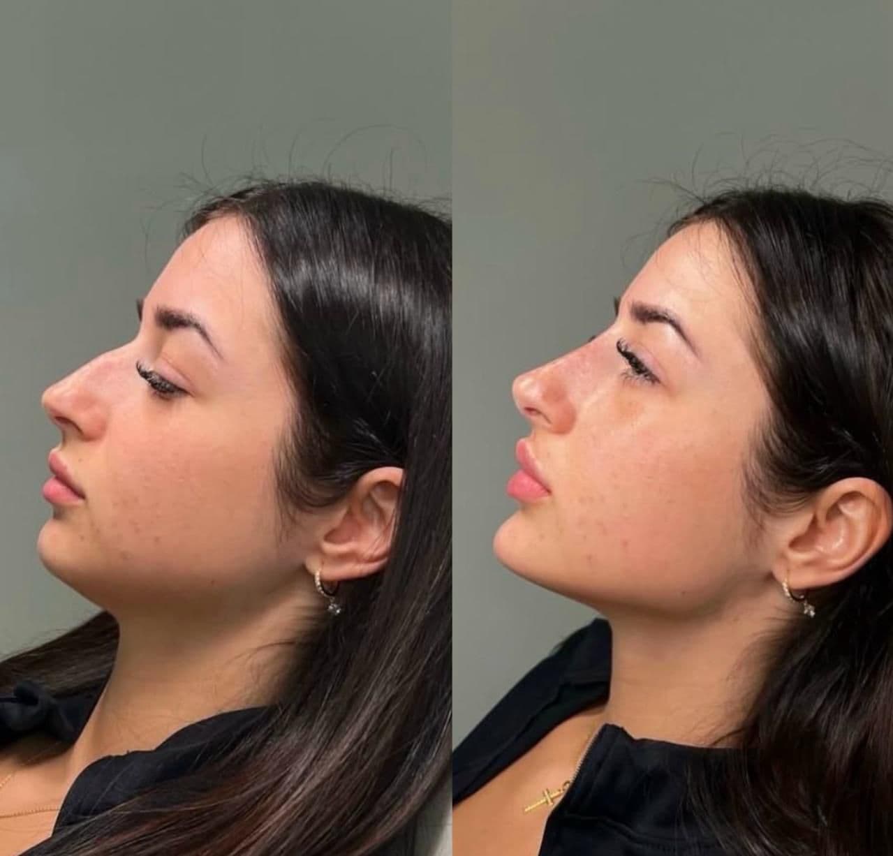 Marcación Mandíbula y Rinomodelación