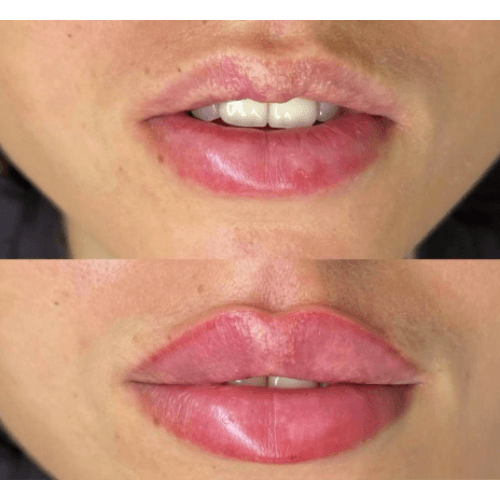 Armonización Facial